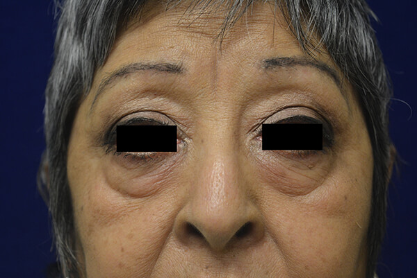01-Bleph-Lower_Patient-1_PreOp 01-Bleph-Lower_Patient-1_PreOp