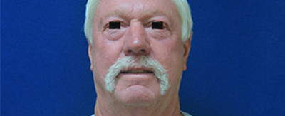 01-Facelift-pat-2-before 01-Facelift-pat-2-before