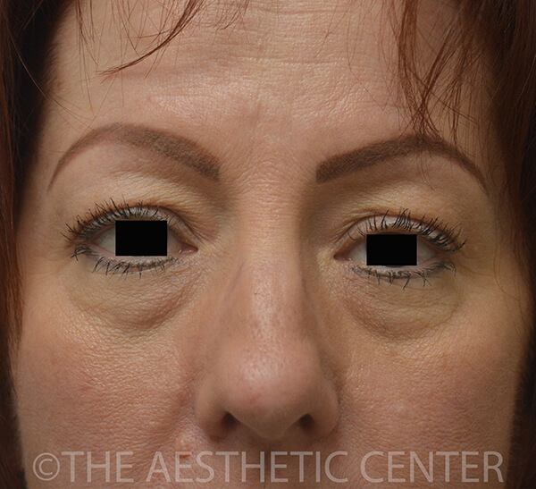 01-Lower-Blepharoplasty-Preop-Front-1-1 01-Lower-Blepharoplasty-Preop-Front-1-1