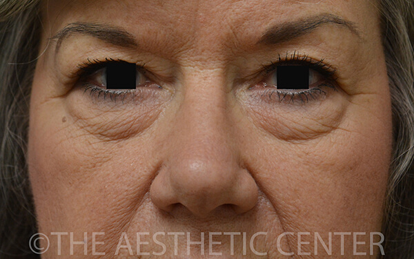 01-Lower-Blepharoplasty-Preop-Front-2 01-Lower-Blepharoplasty-Preop-Front-2