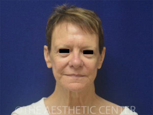 01-Patient-4-before 01-Patient-4-before