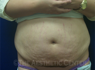 01-abdominoplasty_before_front 01-abdominoplasty_before_front