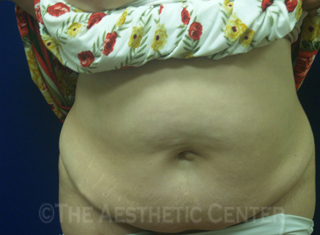01-abdominoplasty_before_front04 01-abdominoplasty_before_front04