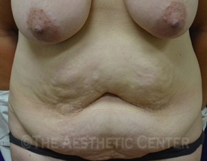 01-abdominoplasty_beforer_front2 01-abdominoplasty_beforer_front2
