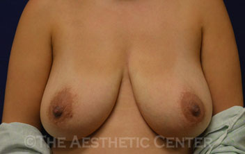01-breastlift_aug_anchor_before_front03 01-breastlift_aug_anchor_before_front03