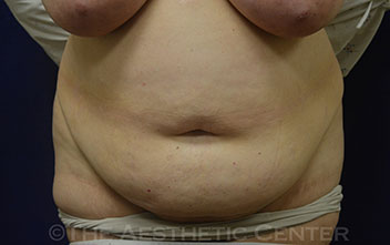 01-tummy-tuck_pat-7_preop_83 01-tummy-tuck_pat-7_preop_83