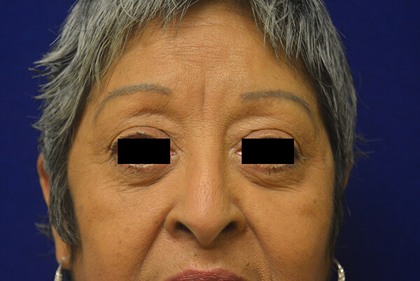 02-Bleph-Lower_Patient-1_PostOp 02-Bleph-Lower_Patient-1_PostOp