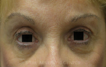 02-Browlift-pat-1 02-Browlift-pat-1