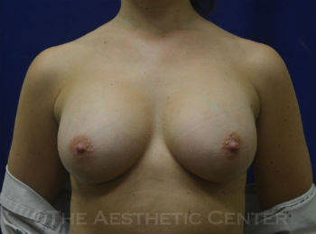 02-Brst-aug_pat-7_postop_7638-1