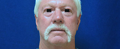 02-Facelift-pat-2-after 02-Facelift-pat-2-after
