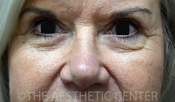 02-Lower-Blepharoplasty-Postop-Front-2 02-Lower-Blepharoplasty-Postop-Front-2