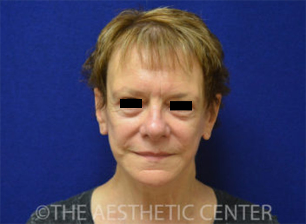 02-Patient-4-after 02-Patient-4-after
