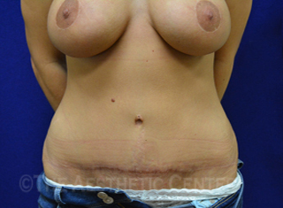 02-abdominoplasty_after_front01 02-abdominoplasty_after_front01