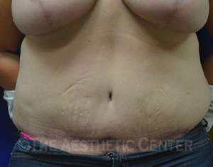 02-abdominoplasty_after_front02 02-abdominoplasty_after_front02