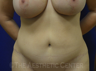 02-abdominoplasty_after_front04 02-abdominoplasty_after_front04