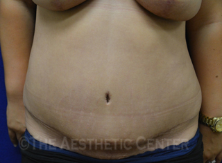 02-abdominoplasty_after_front05 02-abdominoplasty_after_front05