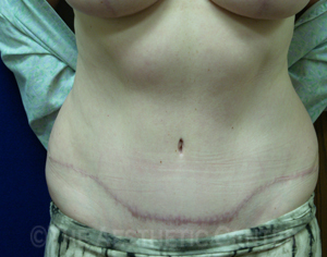 02-abdominoplasty_after_front3 02-abdominoplasty_after_front3
