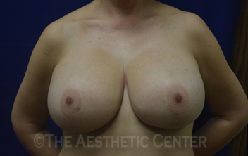 02-breastlift_anchor_after_front02 02-breastlift_anchor_after_front02