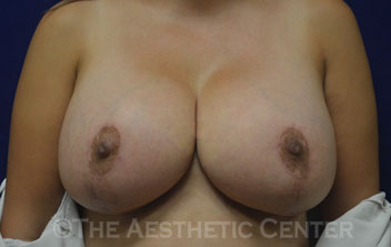 02-breastlift_aug_anchor_after_front03 02-breastlift_aug_anchor_after_front03