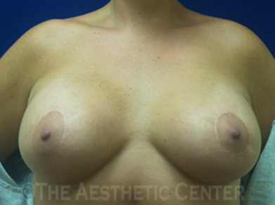 02-perilift_front_after_patient3 02-perilift_front_after_patient3