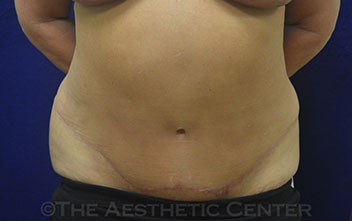 02-tummy-tuck_pat-7_postop_55 02-tummy-tuck_pat-7_postop_55
