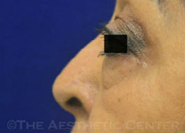 03-Bleph_lower-lid_preop_8957-10-1-1.1) 03-Bleph_lower-lid_preop_8957-10-1-1.1)