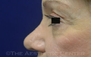 03-Browlift-pat-1 03-Browlift-pat-1
