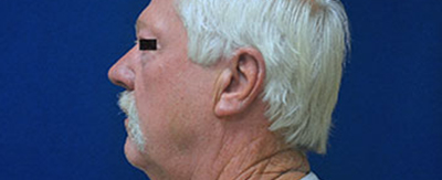 03-Facelift-pat-2-before 03-Facelift-pat-2-before