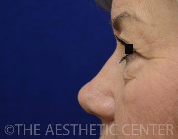 03-Lower-Blepharoplasty-Before-Final-e1577815954985.1) 03-Lower-Blepharoplasty-Before-Final-e1577815954985.1)