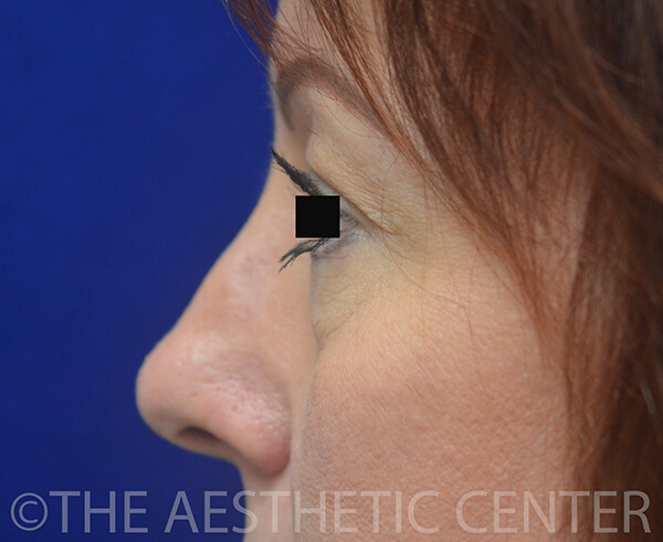 03-Lower-Blepharoplasty-Preop.1) 03-Lower-Blepharoplasty-Preop.1)