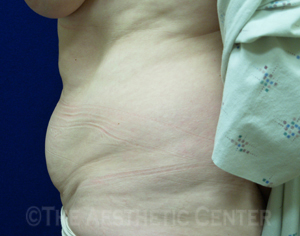 03-abdominoplasty_before_front3 03-abdominoplasty_before_front3