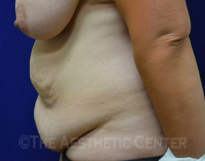03-abdominoplasty_before_side02 03-abdominoplasty_before_side02