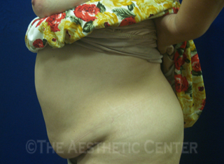 03-abdominoplasty_before_side04 03-abdominoplasty_before_side04