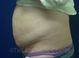 03-abdominoplasty_before_side05 03-abdominoplasty_before_side05