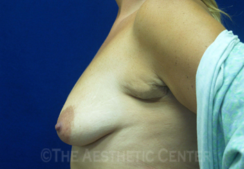 03-perilift_side_before_patient3 03-perilift_side_before_patient3