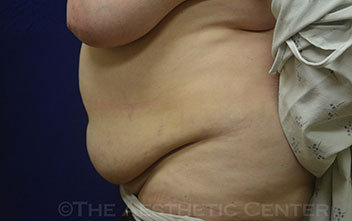 03-tummy-tuck_pat-7_preop_85 03-tummy-tuck_pat-7_preop_85