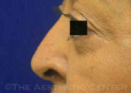 04-Bleph_lower-lid_postop_2037-8-2 04-Bleph_lower-lid_postop_2037-8-2