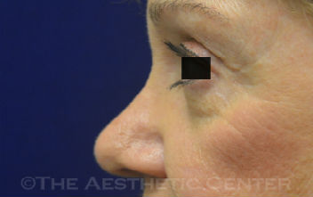 04-Browlift-pat-1 04-Browlift-pat-1