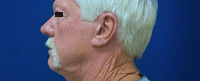 04-Facelift-pat-2-after 04-Facelift-pat-2-after