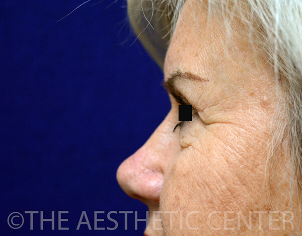 04-Lower-Blepharoplasty-After-1-1 04-Lower-Blepharoplasty-After-1-1