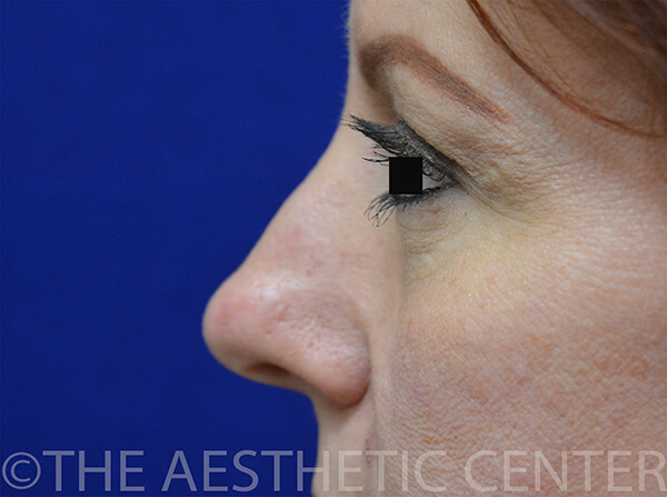 04-Lower-Blepharoplasty-Postop 04-Lower-Blepharoplasty-Postop