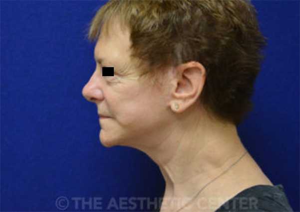 04-Patient-4-after 04-Patient-4-after