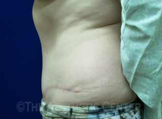 04-abdominoplasty_after_side03 04-abdominoplasty_after_side03