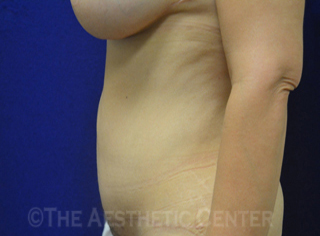 04-abdominoplasty_after_side04 04-abdominoplasty_after_side04