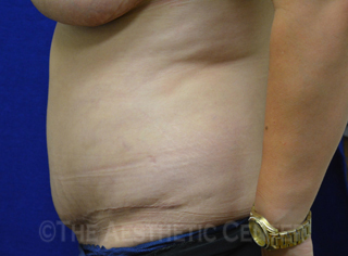 04-abdominoplasty_after_side05 04-abdominoplasty_after_side05
