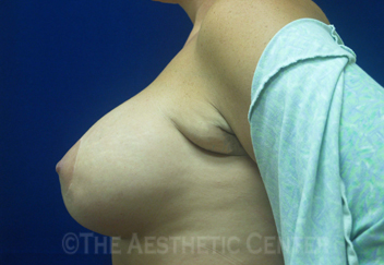 04-perilift_side_after_patient3 04-perilift_side_after_patient3