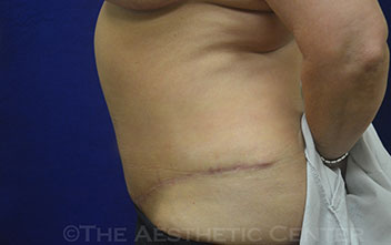 04-tummy-tuck_pat-7_postop_57-2 04-tummy-tuck_pat-7_postop_57-2