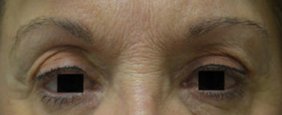 Browlift-pat-1-cover-a