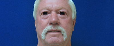 Facelift-pat-2-covera