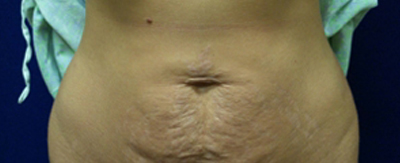 abdominoplasty-pat1-cover abdominoplasty-pat1-cover